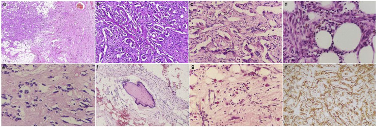 Pelvic retroperitoneal pleomorphic hyalinizing angiectatic tumor: A case report and review of literature.