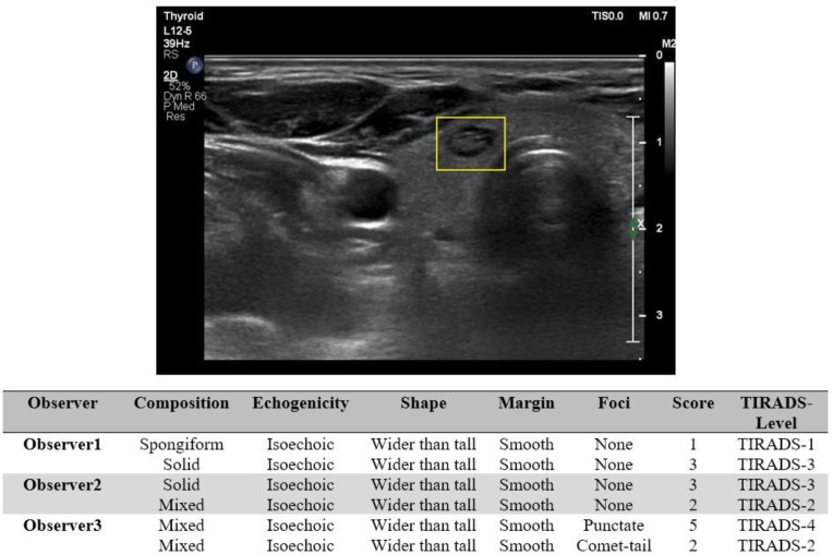 Observation Variation in Ultrasonography Assessment of Thyroid Nodules.