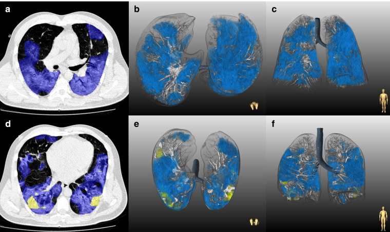 Radiomorphological signs and clinical severity of SARS-CoV-2 lineage B.1.1.7.