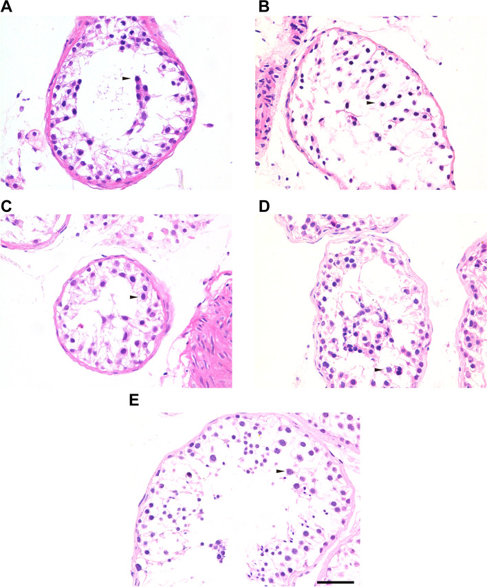 Novel bi-allelic MSH4 variants causes meiotic arrest and non-obstructive azoospermia.
