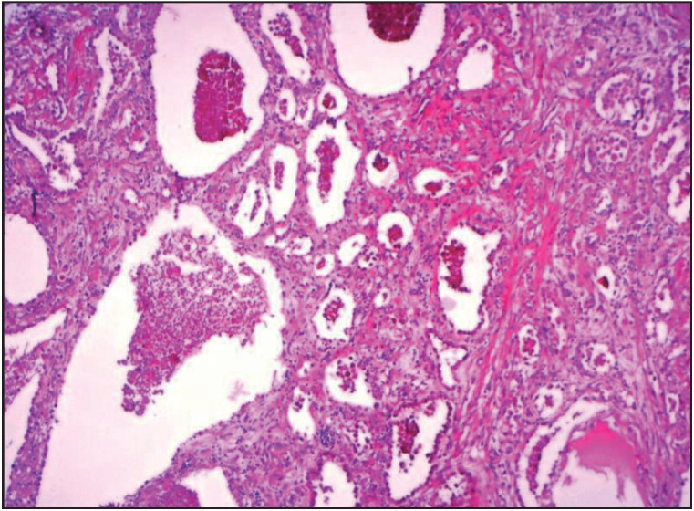 Alveolar Adenoma: A Rare Benign Tumour of the Lung with A Challenging Diagnosis.