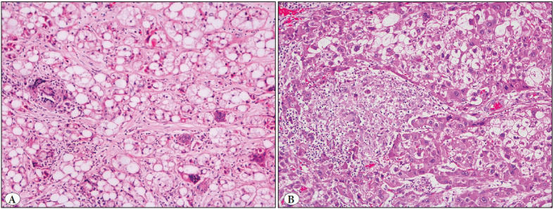 Hepatocellular Carcinomas with Granulomatous Inflammation In Tumor Stroma: Clinicopathologic Characteristics.