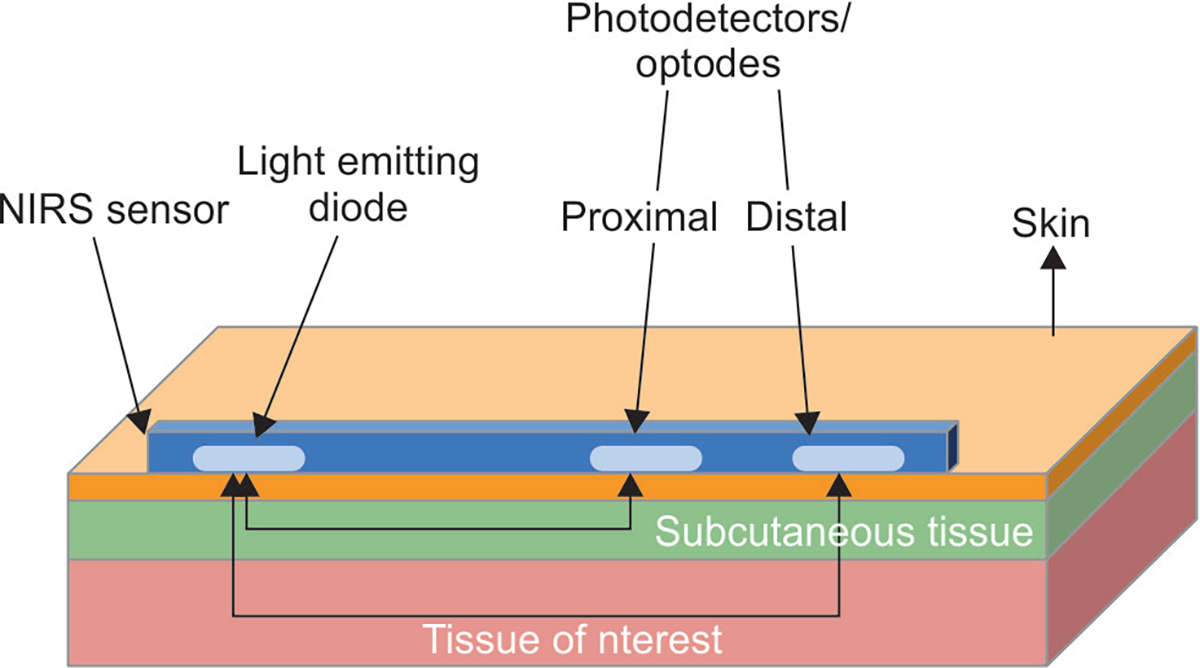 Role of Near-infrared Spectroscopy in the Diagnosis and Assessment of Necrotizing Enterocolitis.