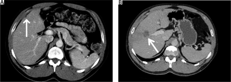 Liver metastasis or a pseudocyst? A rare presentation of leiomyosarcoma's metastasis in the liver.