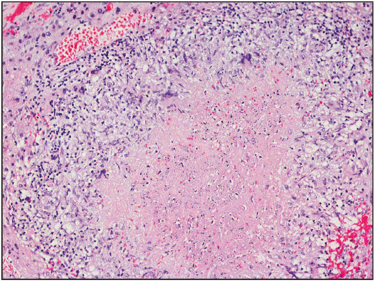 Hepatocellular Carcinomas with Granulomatous Inflammation In Tumor Stroma: Clinicopathologic Characteristics.