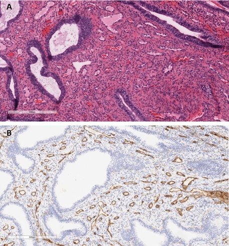 Uterine Hemangioma Presenting as an Endometrial Polyp in a Postmenopausal Woman.