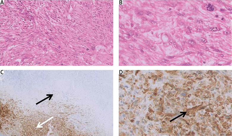 Liver metastasis or a pseudocyst? A rare presentation of leiomyosarcoma's metastasis in the liver.