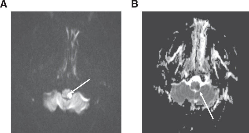 Case Report: COVID-19 Infection and Cervical Artery Dissection.