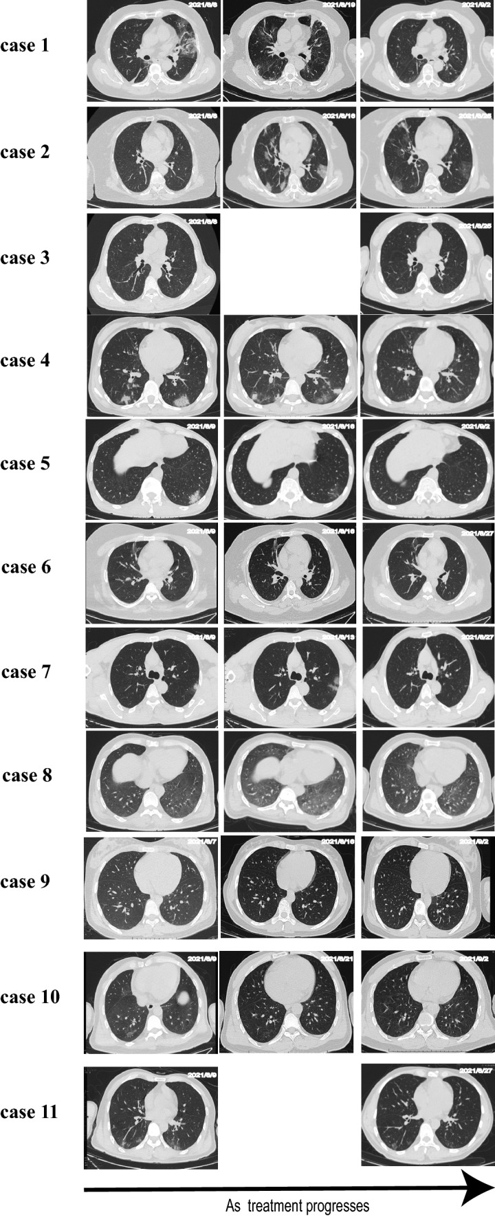 Characteristics of COVID-19 (Delta Variant)/HIV Co-infection: A Cross-sectional Study in Henan Province, China.