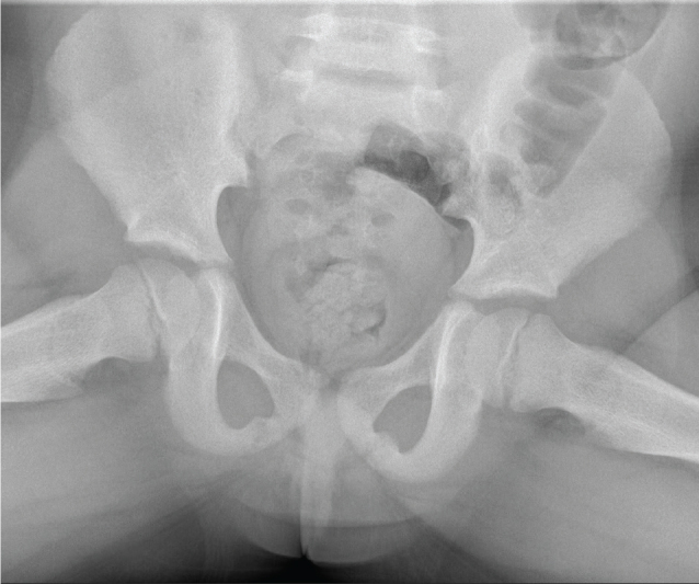 OSTEOCHONDROSES IN CHILDREN'S SPORTS PRACTICE - A RARE CASE OF VAN NECK-ODELBERG DISEASE.