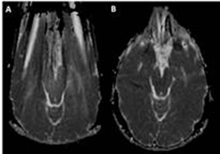 Diffusion-weighted MR imaging of musculoskeletal tissues: incremental role over conventional MR imaging in bone, soft tissue, and nerve lesions.