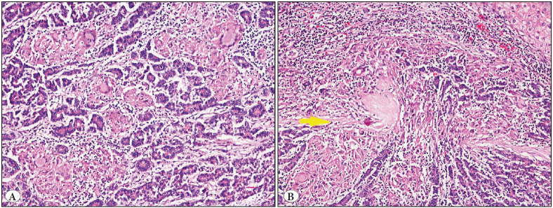 Hepatocellular Carcinomas with Granulomatous Inflammation In Tumor Stroma: Clinicopathologic Characteristics.