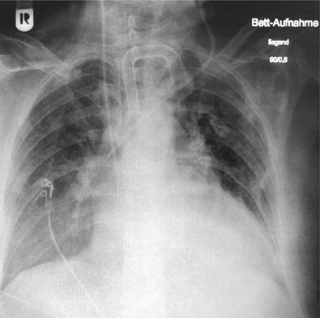 [Rare superinfection in a COVID-19 patient-A chronology].