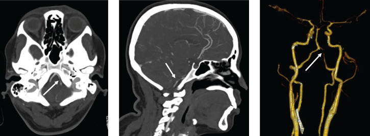 Case Report: COVID-19 Infection and Cervical Artery Dissection.