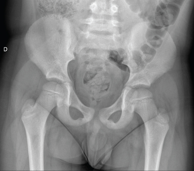 OSTEOCHONDROSES IN CHILDREN'S SPORTS PRACTICE - A RARE CASE OF VAN NECK-ODELBERG DISEASE.