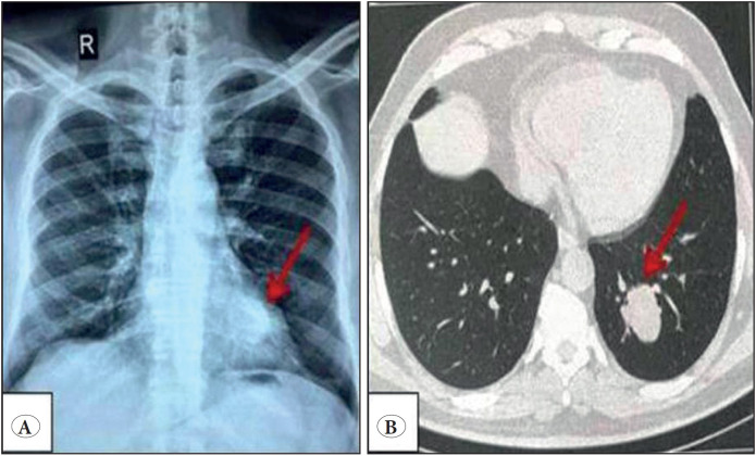 Alveolar Adenoma: A Rare Benign Tumour of the Lung with A Challenging Diagnosis.