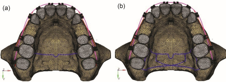 Comparison of the effectiveness of butterfly arch versus transpalatal arch in anchorage reinforcement: A linear 3D finite element study.