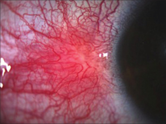 Tubercular Episcleritis: A Review of Literature.