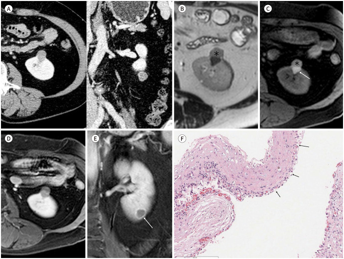 Multilocular Cystic Renal Neoplasm of Low Malignant Potential: A Case Report and Literature Review.