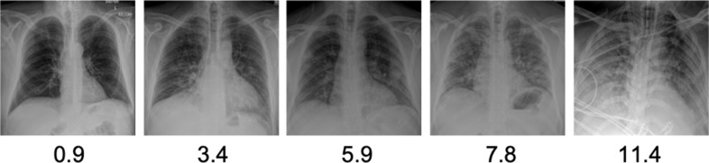 Intubation and mortality prediction in hospitalized COVID-19 patients using a combination of convolutional neural network-based scoring of chest radiographs and clinical data.