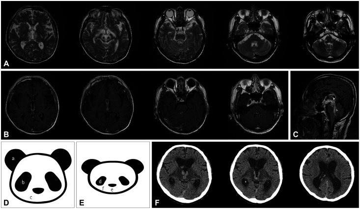 Isolated Vestibular Syndrome With "Double-Panda" Sign in CNS Lymphoma.