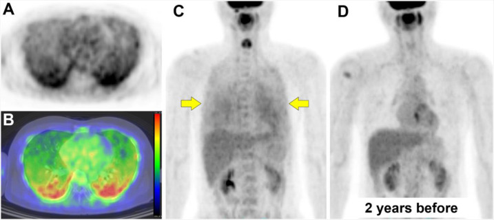 Diffuse FDG uptake in the bilateral lungs: hypersensitivity pneumonitis supported by low-dose CT findings.