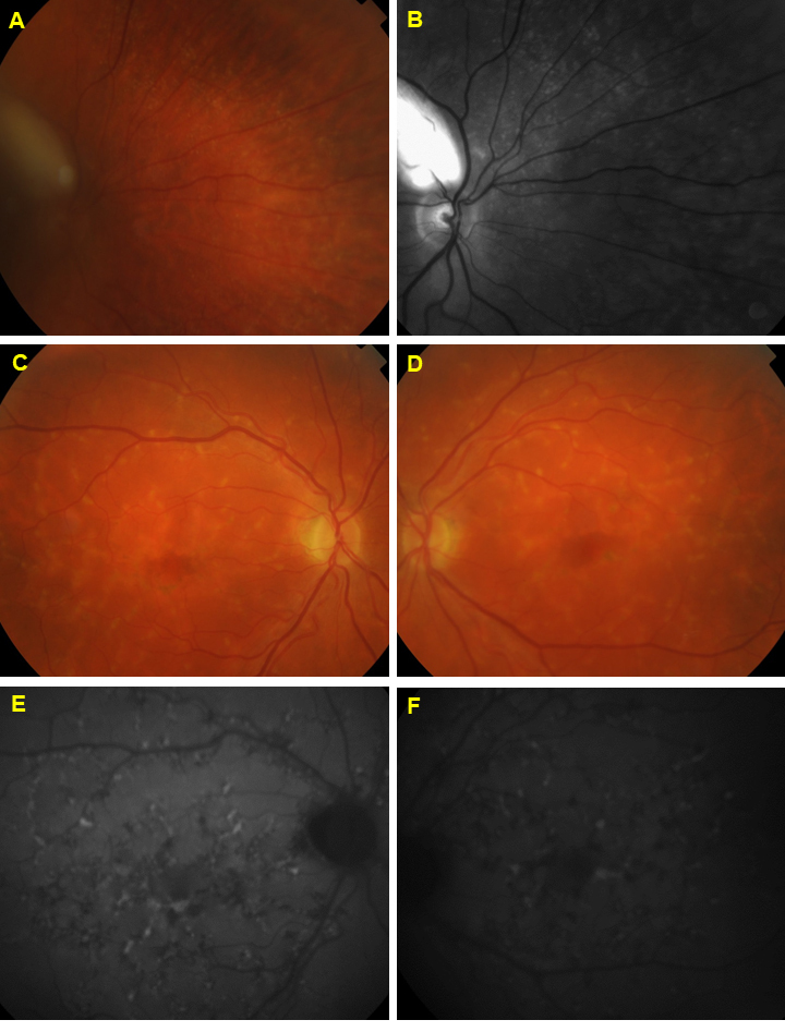 A five-year follow-up of <i>ABCA4</i> carriers showing deterioration of retinal function and increased structural changes.