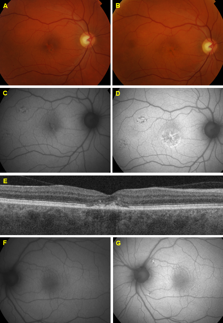 A five-year follow-up of <i>ABCA4</i> carriers showing deterioration of retinal function and increased structural changes.