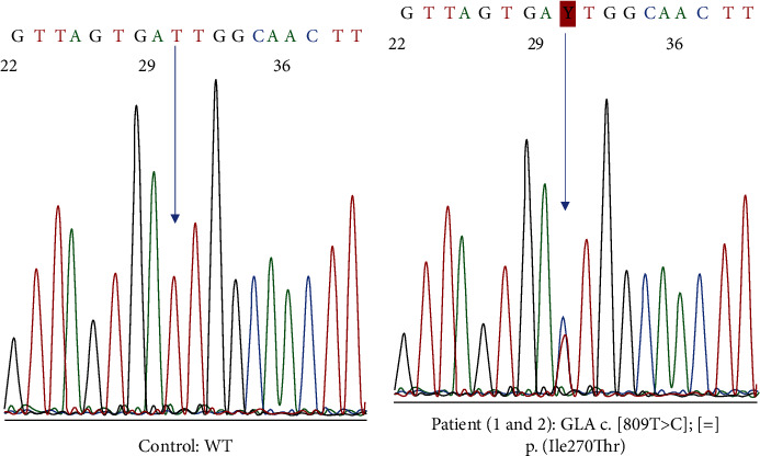 The Benefits of Early versus Late Therapeutic Intervention in Fabry Disease.