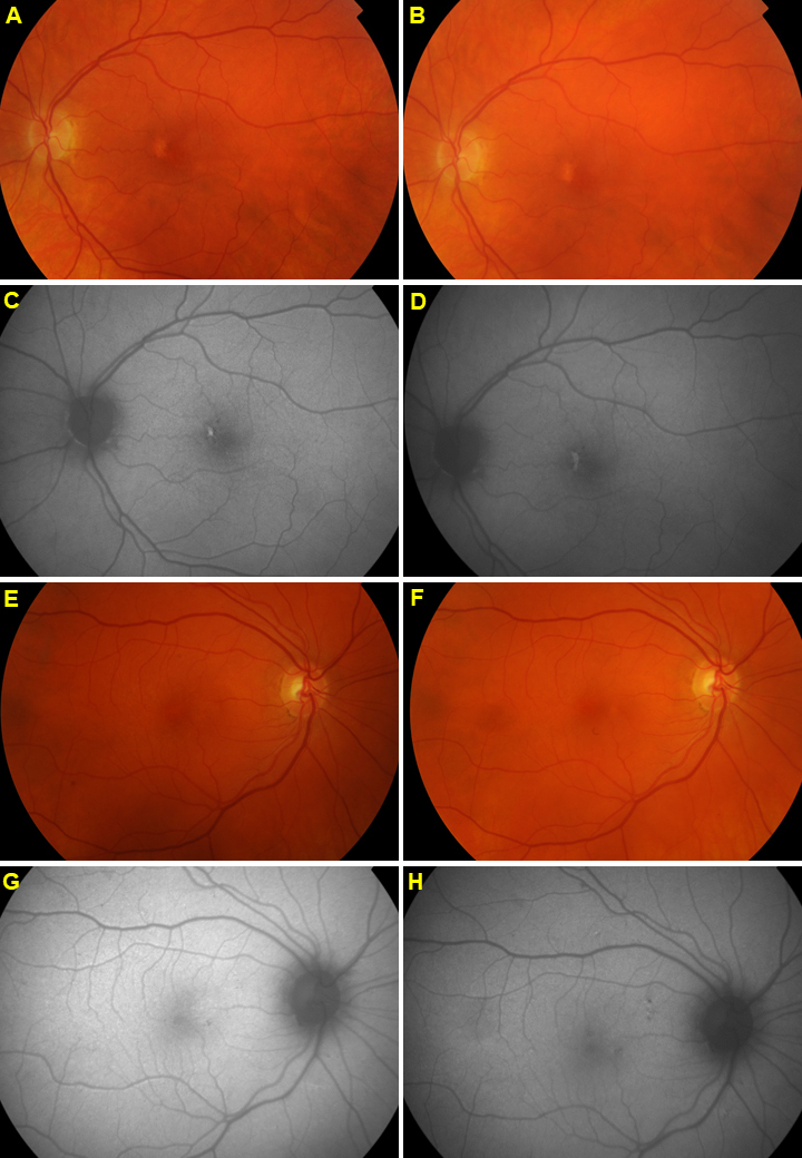 A five-year follow-up of <i>ABCA4</i> carriers showing deterioration of retinal function and increased structural changes.