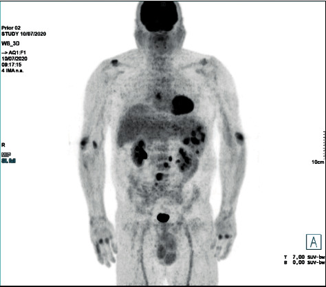 Methotrexate-Associated Lymphoproliferative Disorder in a Patient with Psoriasis: A Case Report and Review of the Literature.