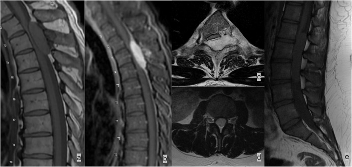 Imaging of metastatic epidural spinal cord compression.