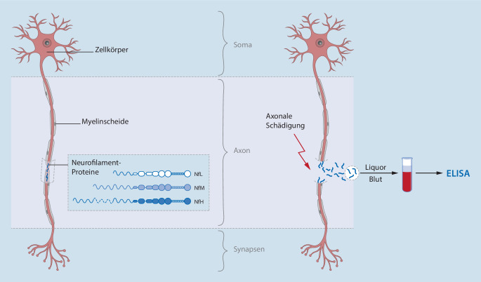 [Which biomarkers for diagnosis and guidance of anti-infection treatment in sepsis?]