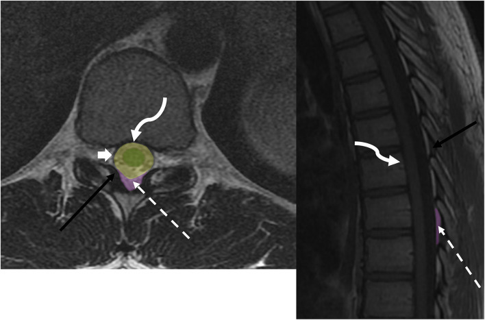 Imaging of metastatic epidural spinal cord compression.