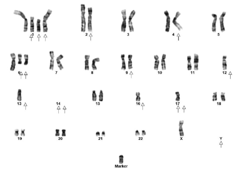 Cytogenetic Abnormalities in Multiple Myeloma: Incidence, Prognostic Significance, and Geographic Heterogeneity in Indian and Western Populations.