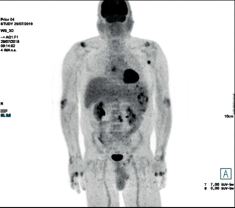 Methotrexate-Associated Lymphoproliferative Disorder in a Patient with Psoriasis: A Case Report and Review of the Literature.