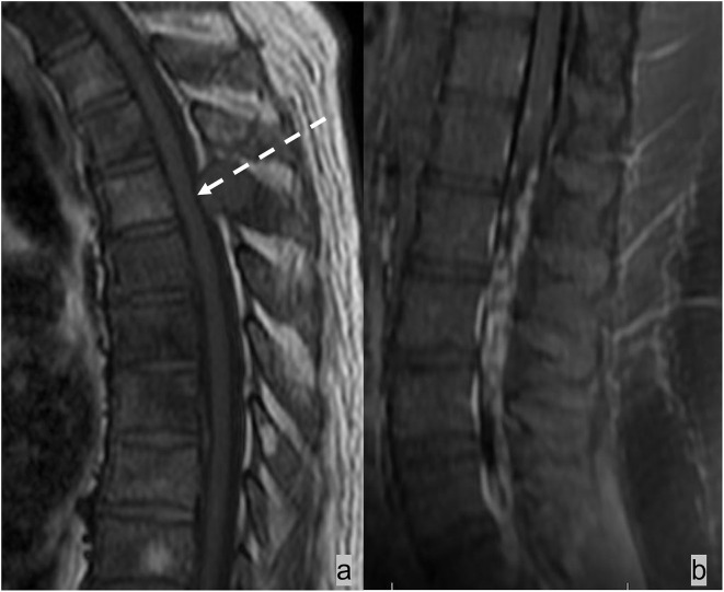 Imaging of metastatic epidural spinal cord compression.