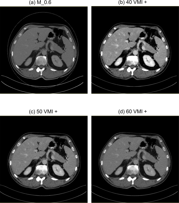 Salvaging low contrast abdominal CT studies using noise-optimised virtual monoenergetic image reconstruction.