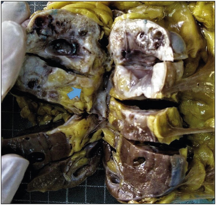 Mixed Epithelial and Stromal Tumor Family of Kidney (Adult Cystic Nephroma, Mixed Epithelial and Stromal Tumor): Retrospective Clinicopathological Evaluation.