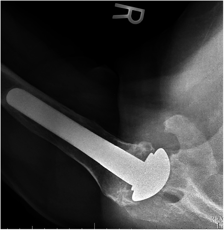 Arthroscopic Removal of the Polyethylene Glenoid Component After Total Shoulder Arthroplasty: A Systematic Review.