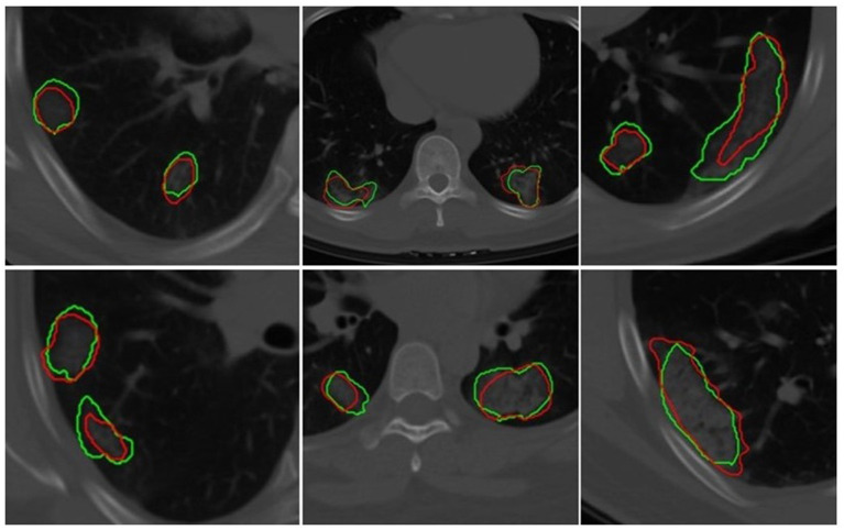 An End-to-End Integrated Clinical and CT-Based Radiomics Nomogram for Predicting Disease Severity and Need for Ventilator Support in COVID-19 Patients: A Large Multisite Retrospective Study.