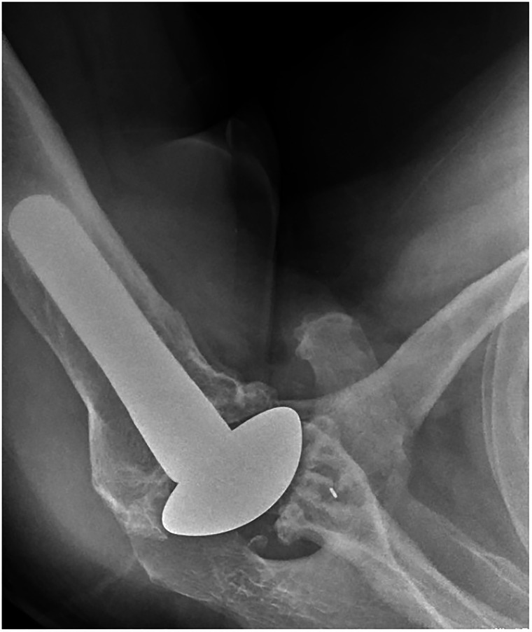 Arthroscopic Removal of the Polyethylene Glenoid Component After Total Shoulder Arthroplasty: A Systematic Review.