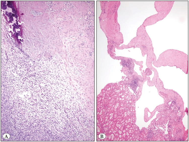 Mixed Epithelial and Stromal Tumor Family of Kidney (Adult Cystic Nephroma, Mixed Epithelial and Stromal Tumor): Retrospective Clinicopathological Evaluation.