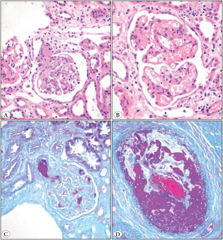 Clinico-Histological Features of Thrombotic Microangiopathy in Renal Biopsies: A Retrospective Study.