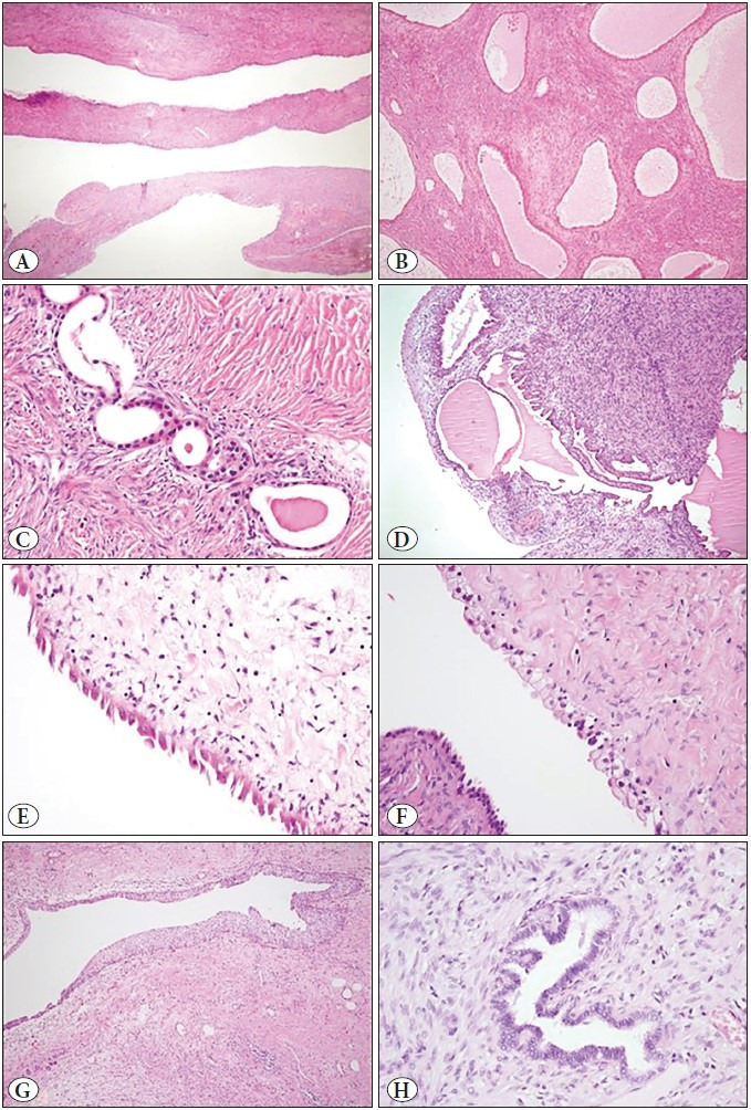 Mixed Epithelial and Stromal Tumor Family of Kidney (Adult Cystic Nephroma, Mixed Epithelial and Stromal Tumor): Retrospective Clinicopathological Evaluation.