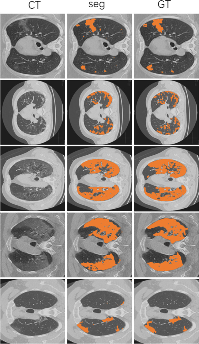 A deep adversarial model for segmentation-assisted COVID-19 diagnosis using CT images.