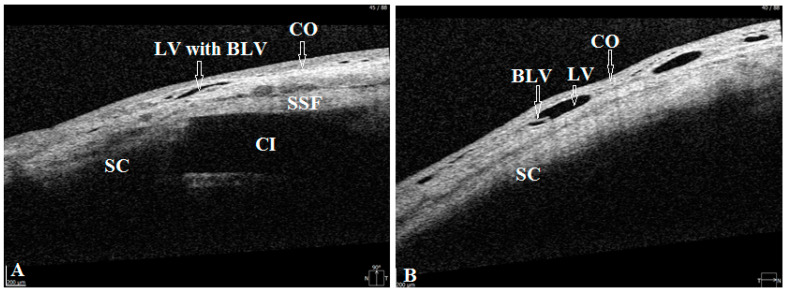 Bleb-Independent Glaucoma Surgery to Activate the Uveolymphatic Route of Non-Trabecular Aqueous Humor Outflow: Short-Term Clinical and OCT Results.