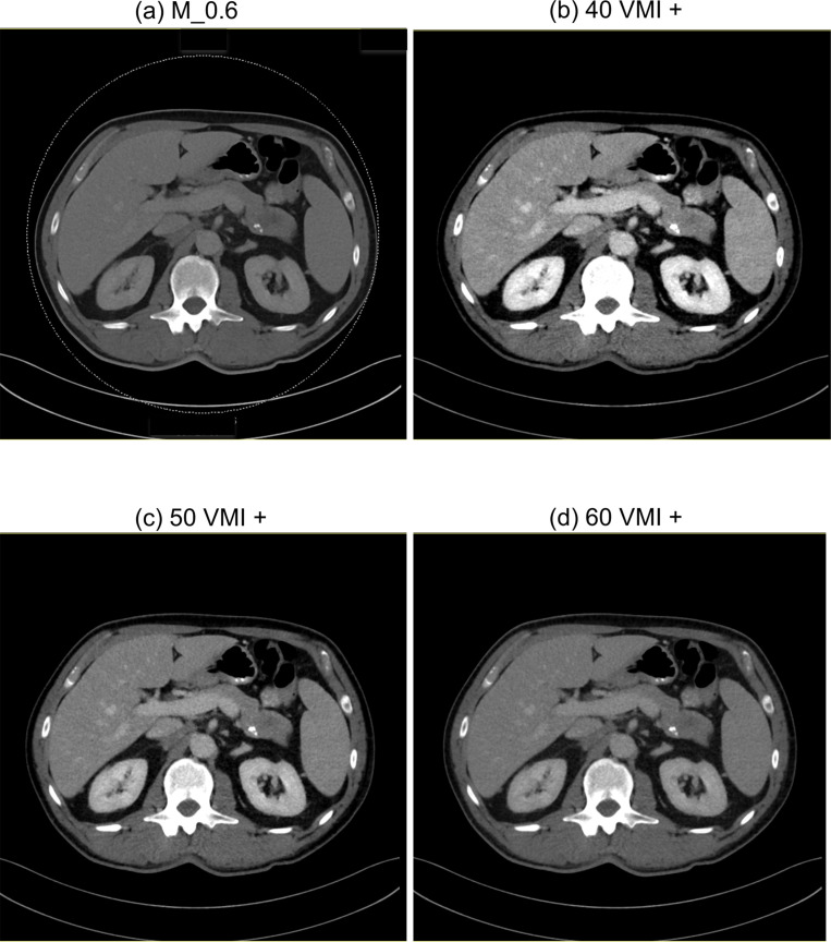 Salvaging low contrast abdominal CT studies using noise-optimised virtual monoenergetic image reconstruction.