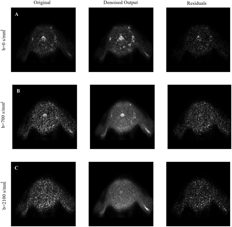 Diffusion Kurtosis Imaging of Neonatal Spinal Cord in Clinical Routine.