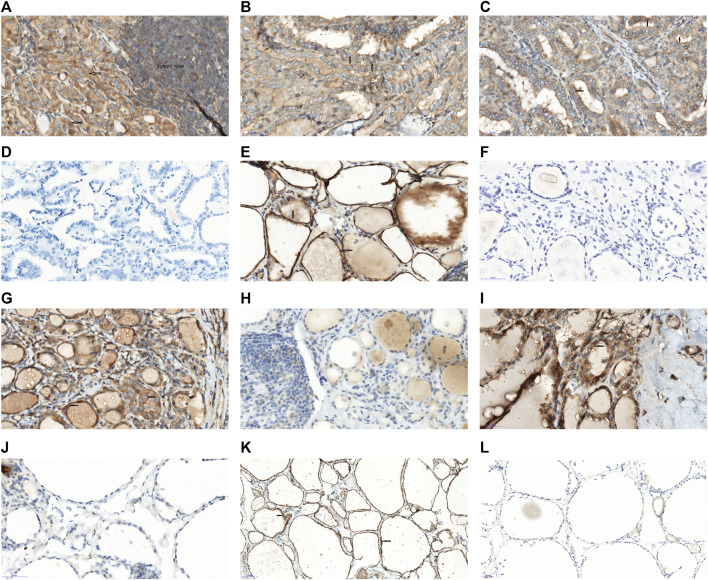 Clinical Significance of PEAK1 Expression and BRAF V600E Mutation in Papillary Thyroid Cancer.